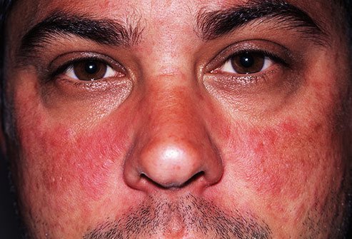 Butterfly rashes across the cheeks are a signature symptom of lupus.