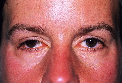 Drooping eyelids are known as ptosis, and can be corrected with surgery.