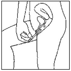 Select the best position for vaginal
insertion of Yuvafem  - Illustration