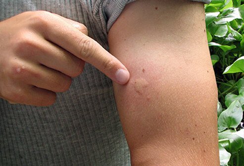 If infected with Zika, it is important to prevent additional mosquito bites.