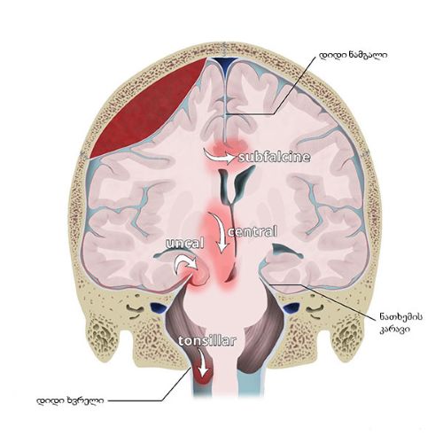 თავის ტვინის ნივთიერების ჩაჭედვის ვარიანტები თავის ტვინის ნივთიერების ჩაჭედვის ვარიანტები.