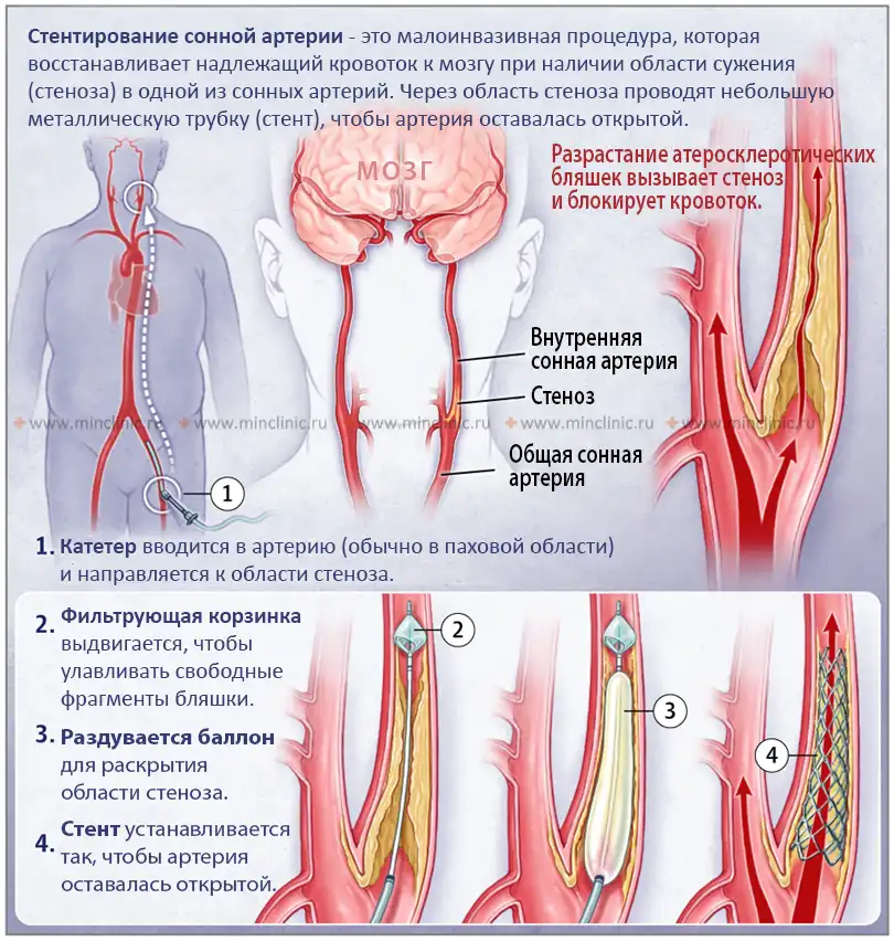 Лечение транзиторных ишемических атак (ТИА, микроинсультов) в бассейне сонной артерии Стентирование сонной артерии - это малоинвазивная процедура, которая восстанавливает надлежащий кровоток к мозгу при наличии области сужения (стеноза) в одной из сонных артерий. Через область стеноза проводят небольшую металлическую трубку (стент), чтобы артерия оставалась открытой.