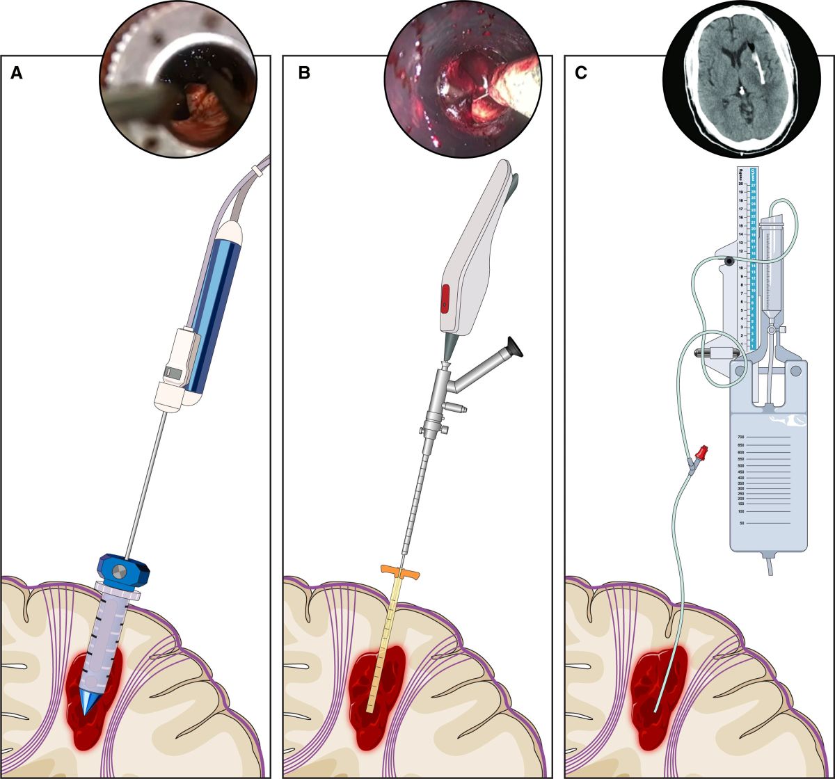 Minimally-invasive chirurgische Techniken bei spontaner intrazerebraler Blutung Minimally-invasive chirurgische Techniken bei spontaner intrazerebraler Blutung