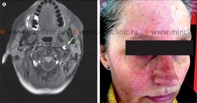 Другие причины инсульта (инфаркта) головного мозга МРТ показывает гематому после расслоения левой внутренней сонной артерии, что сопровождается покраснением лица и повышенным потоотделением у пациента.