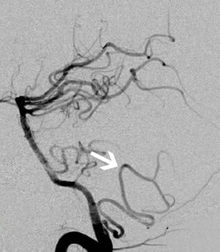 PICA ტონზილარული მარყუჟის ანგიოგრამა ანგიოგრამა აჩვენებს PICA-ს კრანიალურ (ტონზილარულ) მარყუჟს (ისარი).