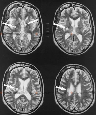MIN — Small-vessel stroke (lacunar infarction)