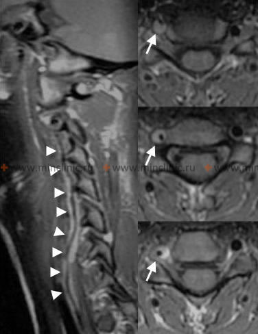ხერხემლის არტერიის დისექცია კისრის მრტ/მრა-ზე კისრის მრტ/მრა აჩვენებს მარჯვენა ხერხემლის არტერიის დისექციის ნიშნებს.