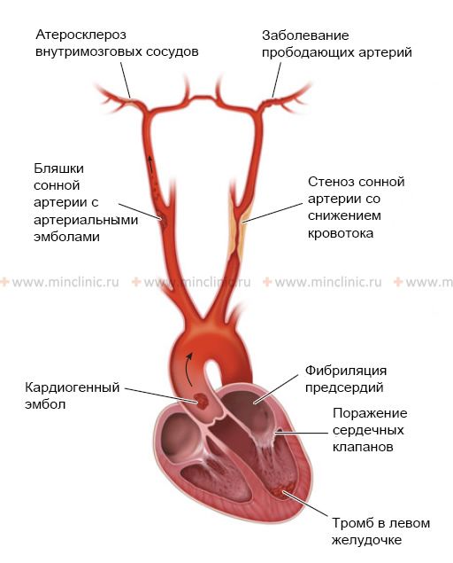 Treatment of transient ischemic attack (TIA) in common carotid artery basin Закупорке внутримозговых сосудов тромбом с периферии (кардиогенным – при фибриляции предсердий, из других артерий – при атеросклеротических бляшках на стенках сонной артерии) часто подвержены крупные артерии.