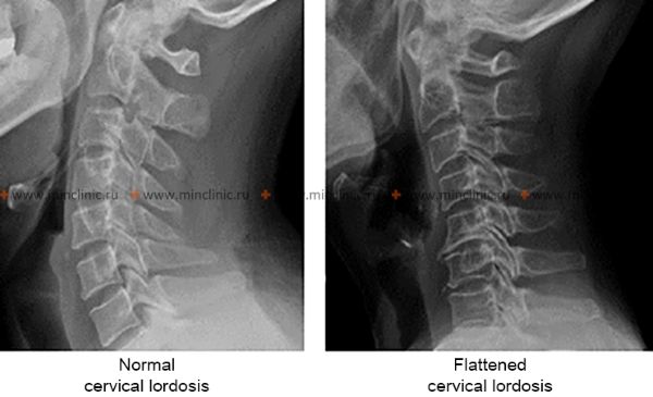Altered Cervical Lordosis on X-ray Lateral X-ray of cervical spine showing altered cervical lordosis (pronounced or smoothed).