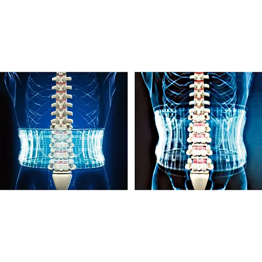 The Lumbar Disc Decompression Belt